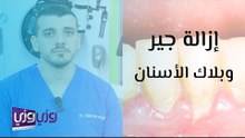 إزالة الجير والبلاك عن الأسنان