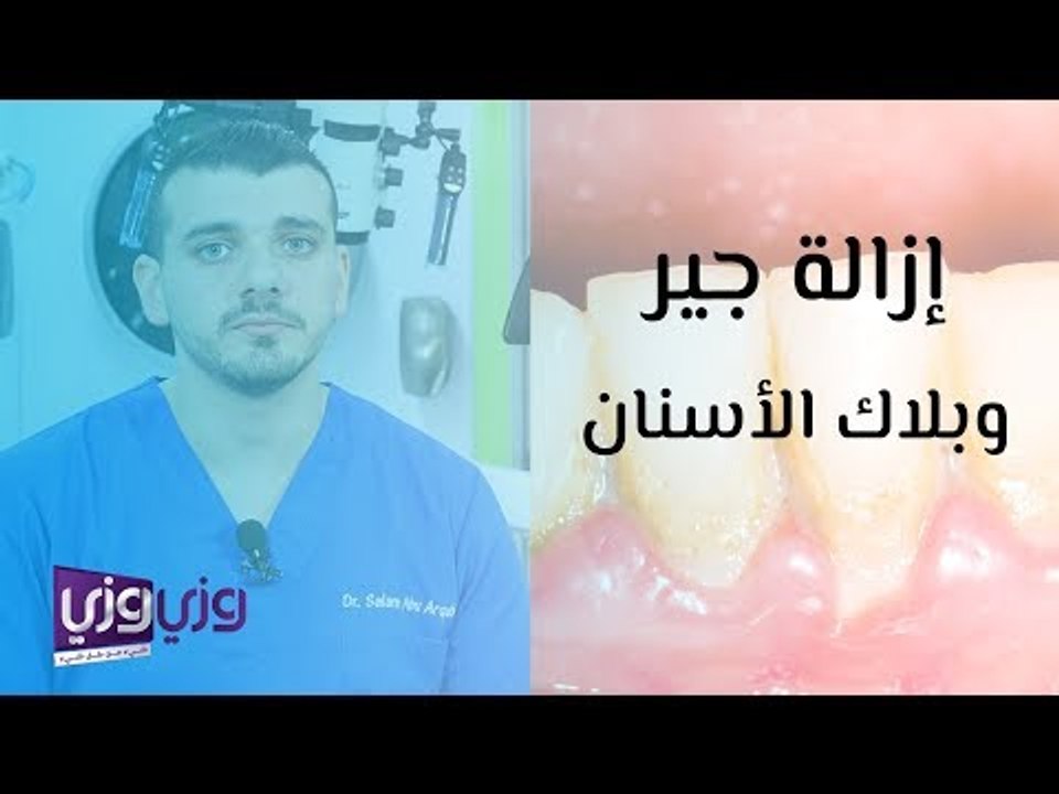 إزالة الجير والبلاك عن الأسنان