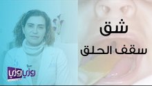 أسباب شق سقف الحلق وعلاجه