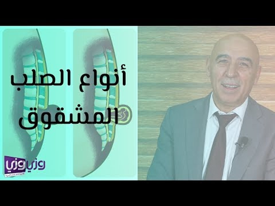 أنواع الصلب المشقوق