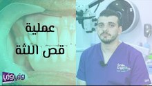 عملية قص اللثة
