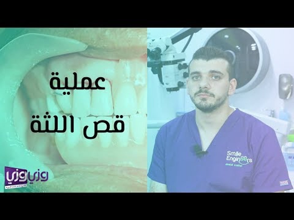 عملية قص اللثة