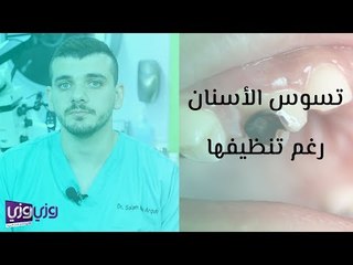 أسباب تسوس الأسنان رغم تنظيفها