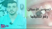 أسباب تسوس الأسنان رغم تنظيفها