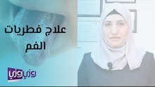علاج فطريات الفم وأهم أسبابها