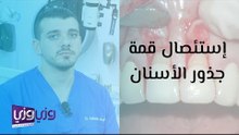 إستئصال قمة جذور الأسنان
