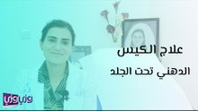 علاج الكيس الدهني تحت الجلد