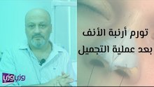 تورم أرنبة الأنف بعد عملية التجميل