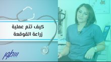 كيف تتم عملية زراعة القوقعة