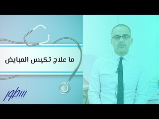 ما علاج تكيس المبايض