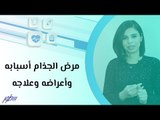 مرض الجذام أسبابه وأعراضه وعلاجه