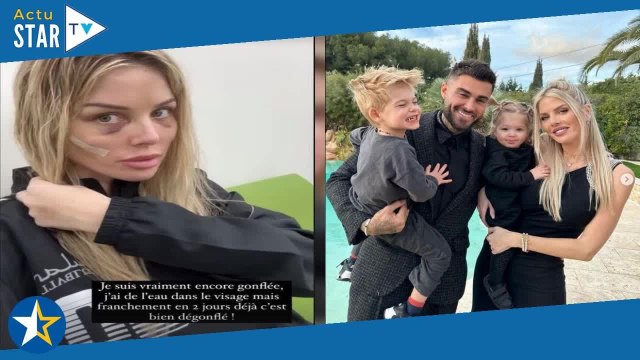 J'ai enlevé mes pansements : Jessica Thivenin dévoile son visage après sa nouvelle opération