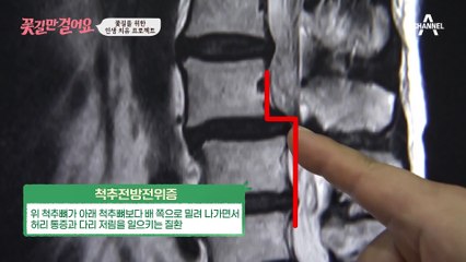 이렇게 쉽게 걸을 수 있다니(T.T) 성공적으로 끝난 영숙 씨의 수술!