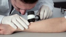 Dermatite atopica: arriva in Italia una nuova arma terapeutica