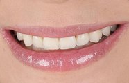Clareamento dental dura a vida toda? Ortodontista sousense explica quais são os tipos e valores