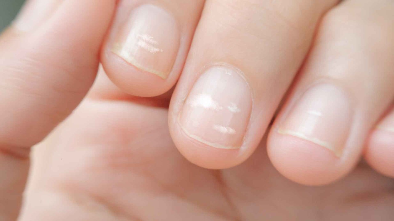 Weiße Flecken auf Fingernägeln: Woher kommen sie und was kann man dagegen tun?