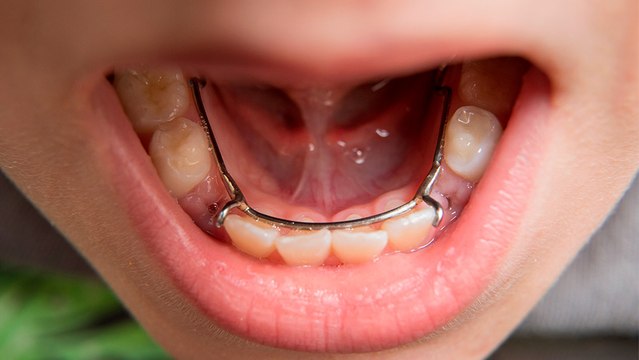 bd-extraccion-de-dientes-temporales-140223