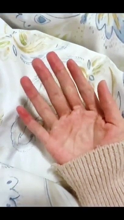 Una mano con seis dedos