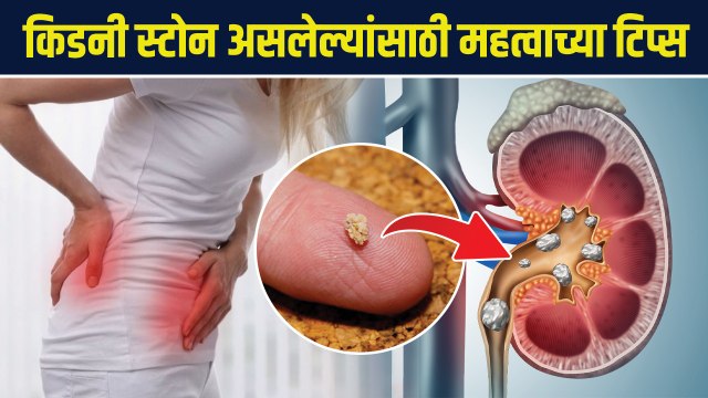 किडनी स्टोन असेल तर 'हे' खाणं टाळा | How to Get Rid of Kidney Stones | kidney stone diet | AS