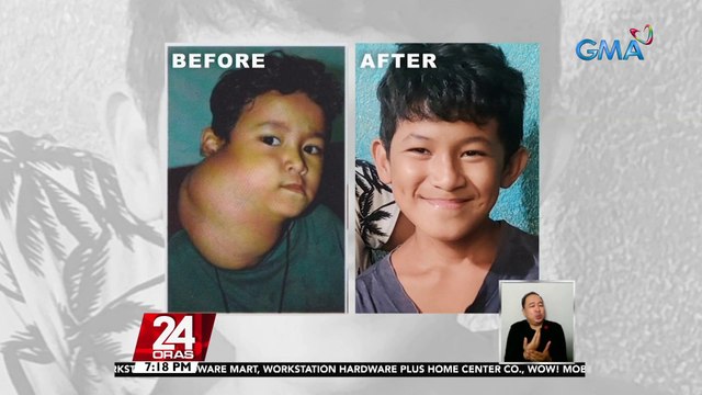Batang may malaking bukol sa leeg, maayos na ang lagay matapos mapa-operahan sa tulong ng GMA Kapuso Foundation | 24 Oras