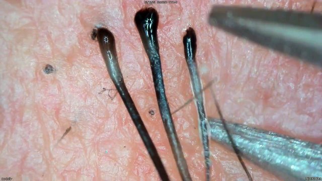 0345 pull out hair Around the nose and lips