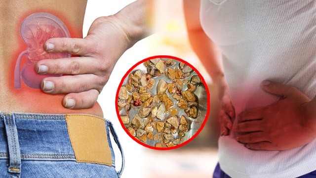 Kidney Stones Symptoms क्या है, Reason जाना जरूरी । Boldsky