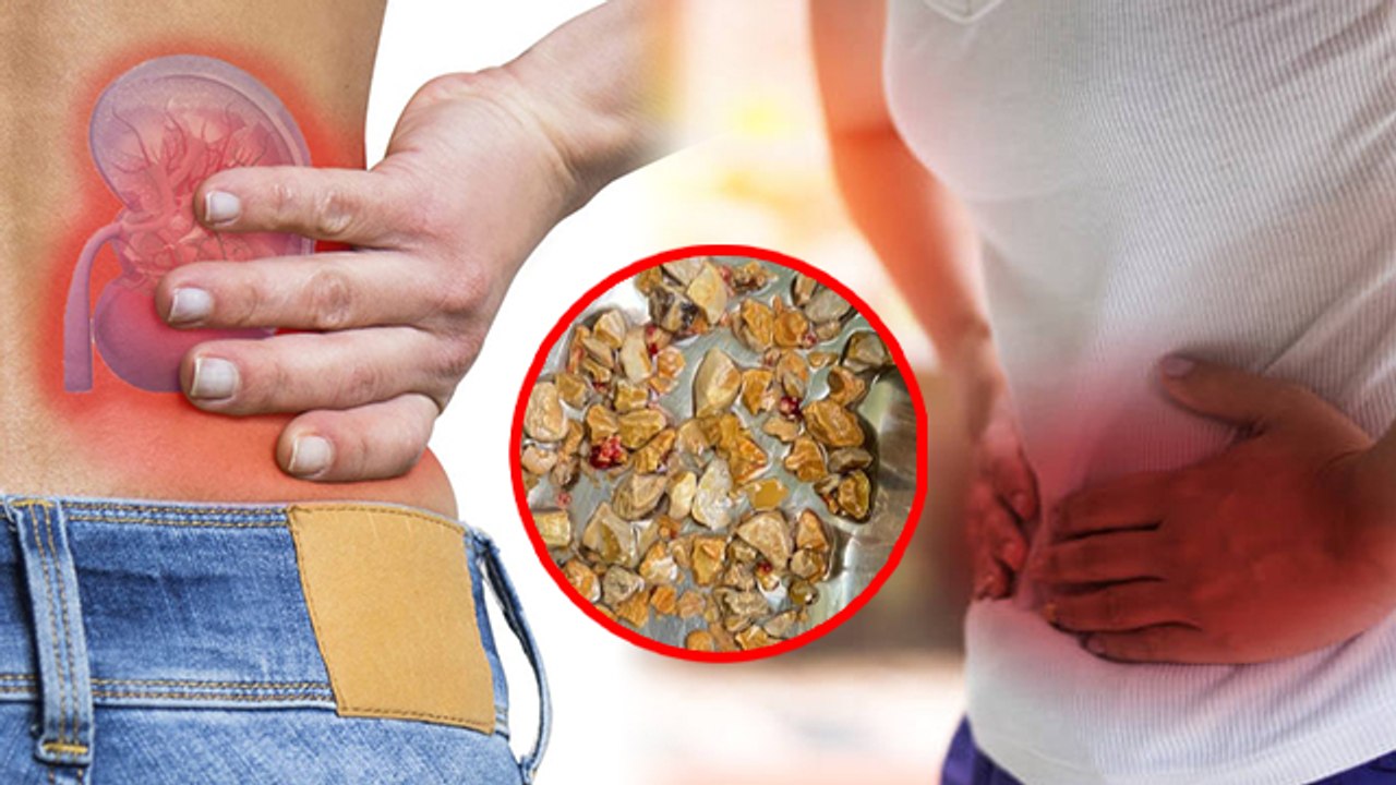 Kidney Stones Symptoms क्या है, Reason जाना जरूरी । Boldsky