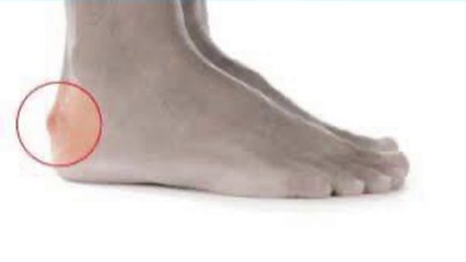 bd-dolor-de-talon-causas-y-tratamientos-210223