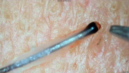 0347 pull out hair around the chin