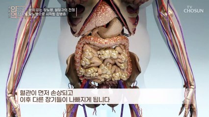 당뇨병 진단 이후 합병증으로 점점 나빠지는 그녀의 건강 TV CHOSUN 230222 방송