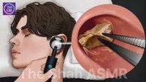 Ear Cleaning and Earwax Removal [ASMR]