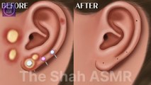 Ear acne removal animation [ASMR]