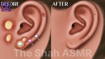Ear acne removal animation [ASMR]