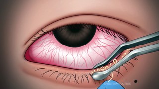 ASMR 속 시원한! 눈꺼풀 피지 압출 애니메이션 | 눈기름샘 짜기 | Satisfying Eyelid Sebum Extrusion Animation