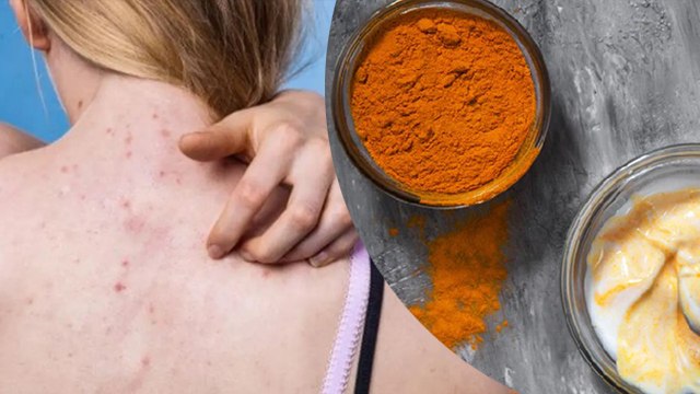 Peeth ke Muhase thik kaise kare | पीठ के मुंहासे का इलाज कैसे करें | Boldsky