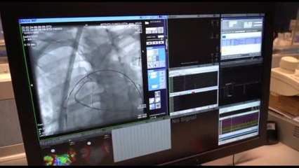 Fibrillazione atriale: Milano dimezza i tempi dei trattamenti