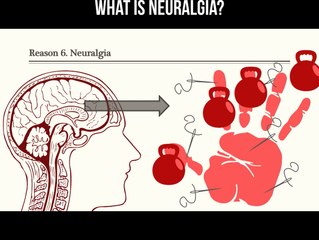Understanding Neuralgia: Symptoms & Causes