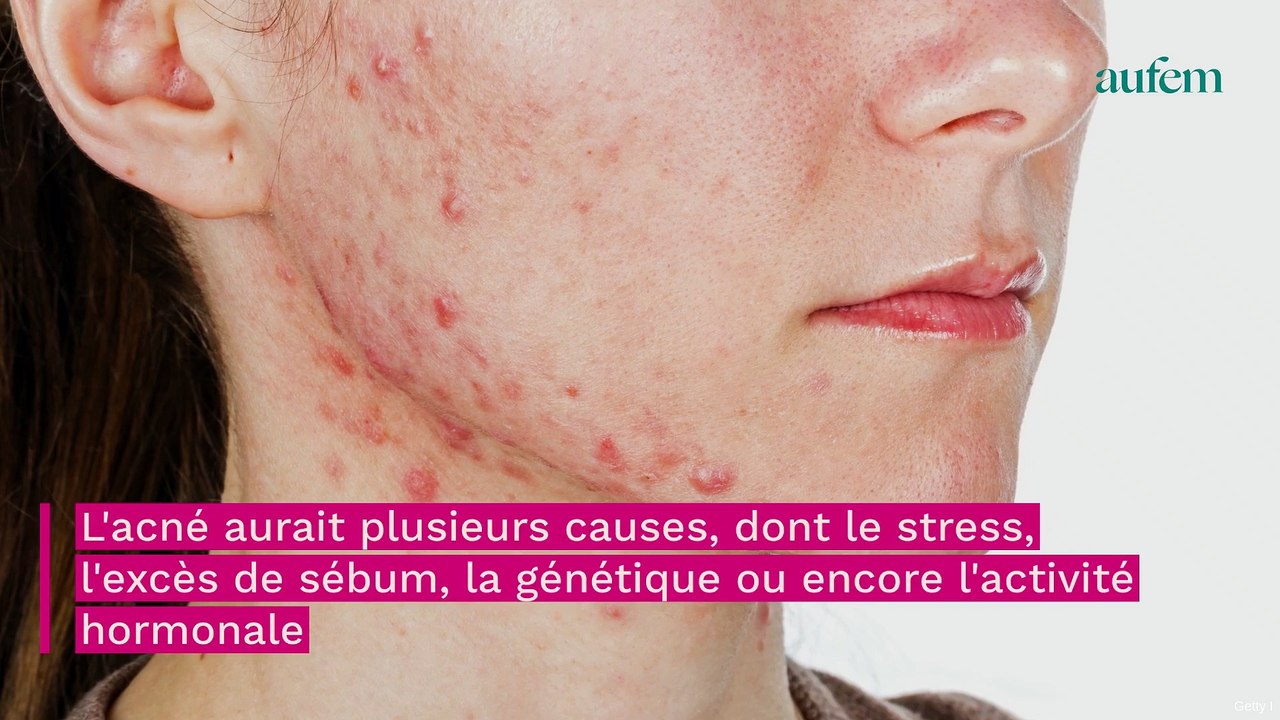 Meilleur sérum anti-acné, comment le choisir pour en finir avec les boutons ?