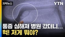 [자막뉴스] 삐끗한 발목에서 발견한 조각... 어머 저게 뭐야? / YTN