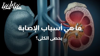 ما هي أسباب الإصابة بحصى الكلى؟