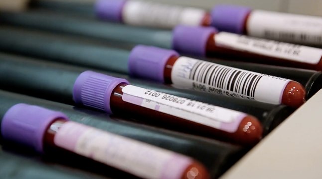 15 Iron Deficiency Signs and Symptoms