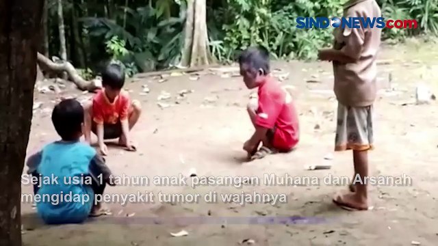 Menderita Tumor Wajah, Bocah di Pandeglang Tetap Ceria Bermain