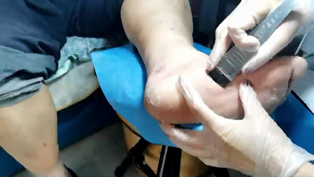 scuffed heels Cheese paws. removing hard skin and dead tissue. Treatment for cracked heels.