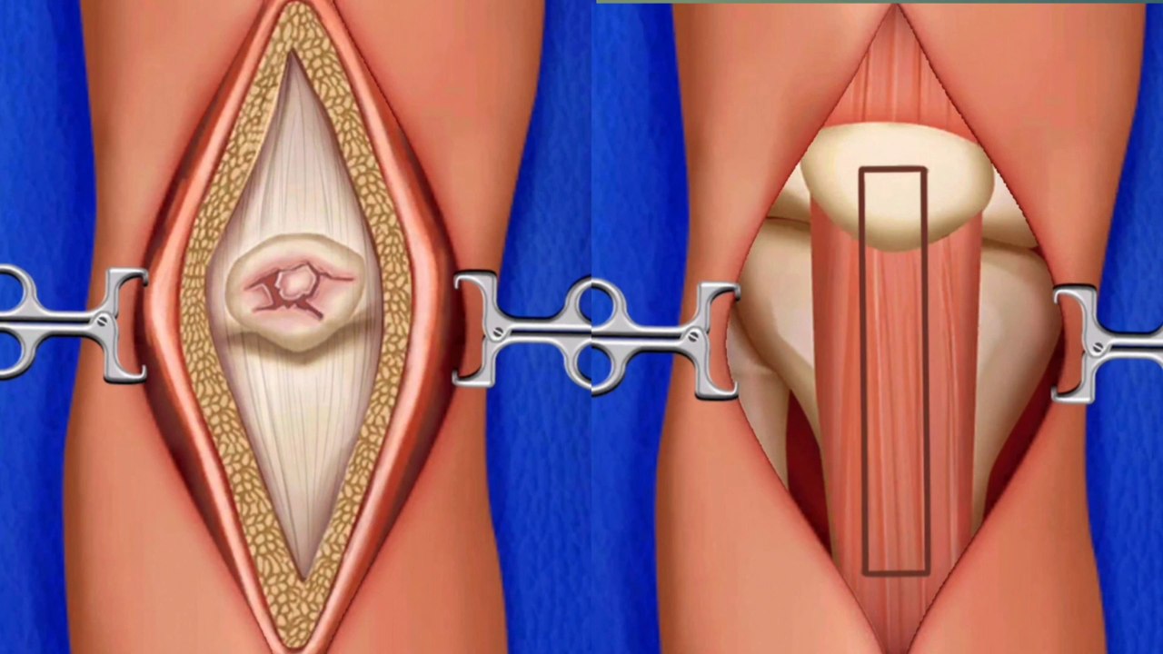 ASMR Satisfying! foot wart treatment | screw nail removal | tingle sound #Mr.DevendraASMR #asmr