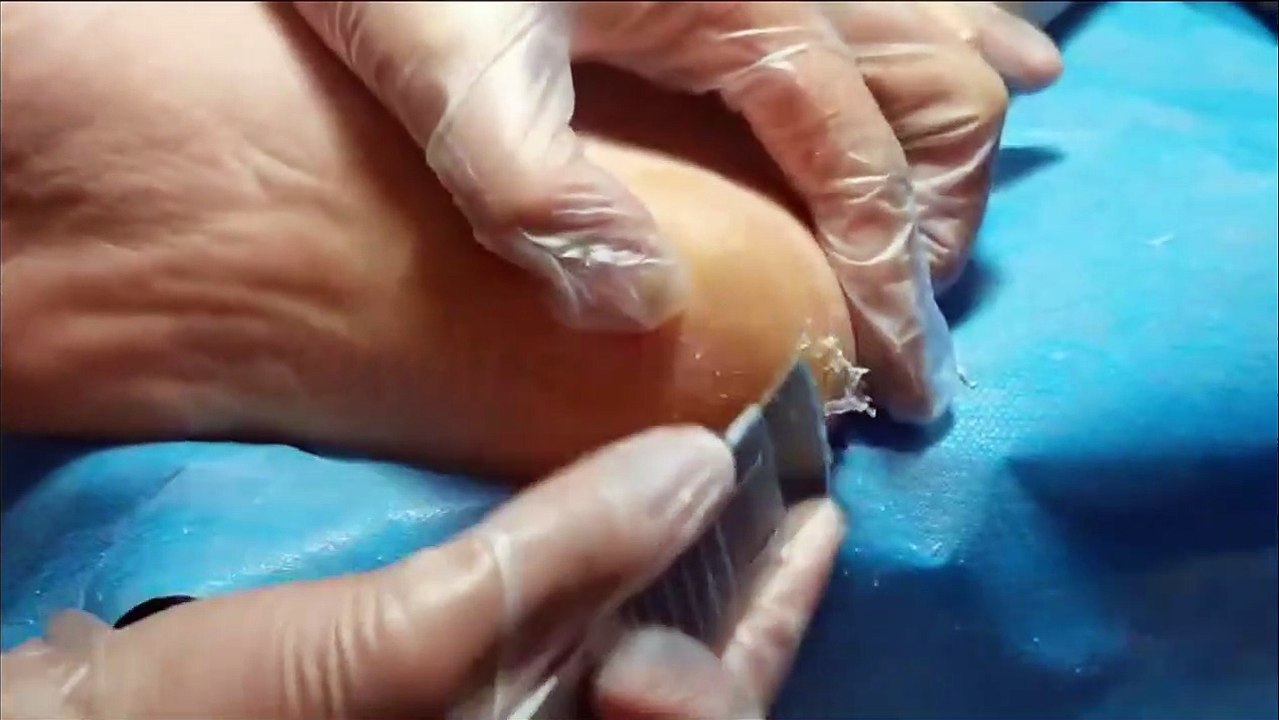 scuffed heels  So fulfilling. Treatment for cracked heels. dry excision of heels.