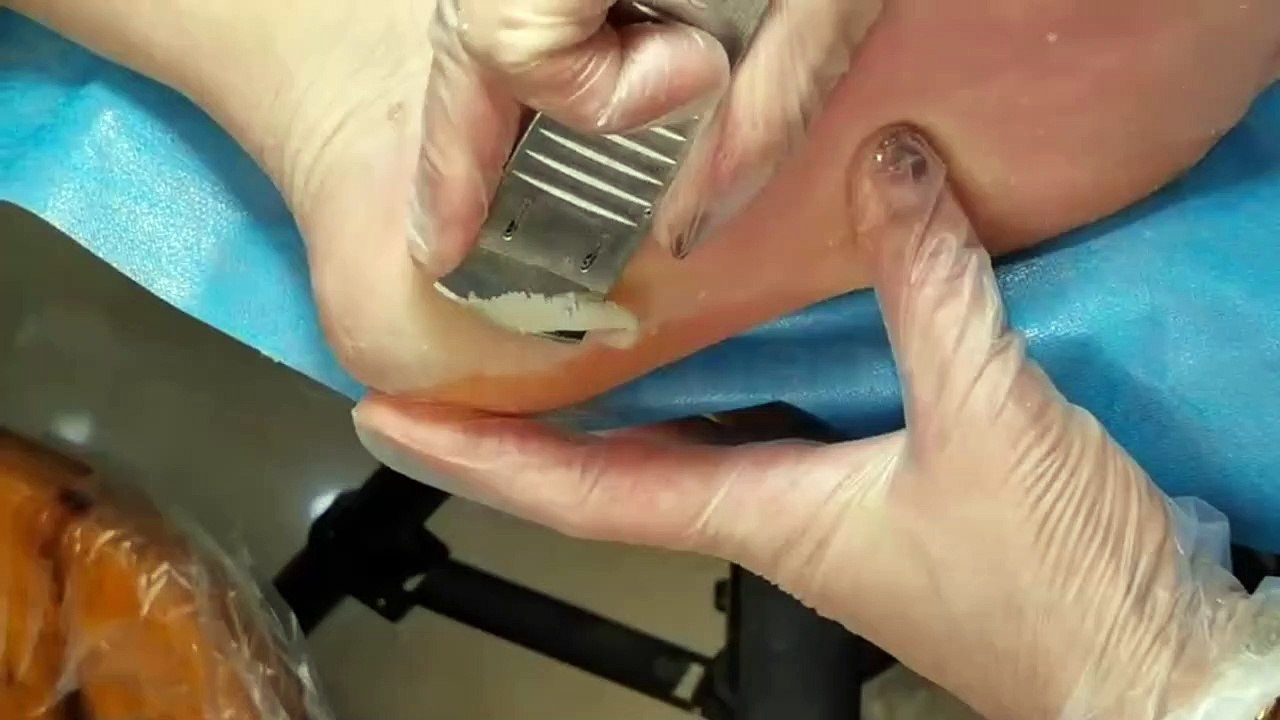 Removal of dead epidermis and treatment for cracked heels. Customer feels improved.