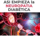 Asi Empieza La Neuropatia Diabetica