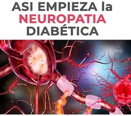 Asi Empieza La Neuropatia Diabetica