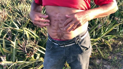 Toinho de Lurdinha de Pedras de perdeu um Rim e precisa de um benefício.