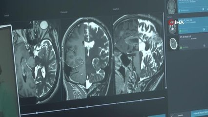 Epilepsi hastası şifayı Türkiye'de beyin pili ameliyatında buldu